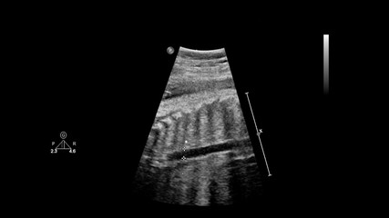 Ultrasound screen with fetal echocardiography.