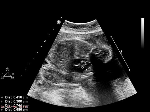 Ultrasound Screen With Fetal Echocardiography.