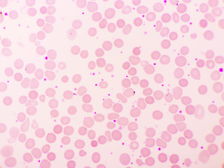 Essential thrombocytosis blood smear, present abnormal high platelet, analyze by microscope