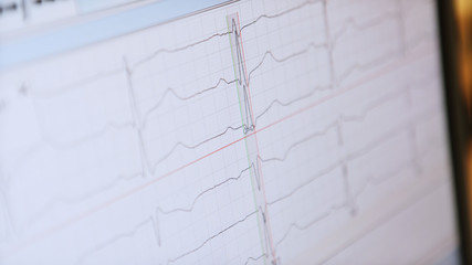 ECG waves on the hospital monitor