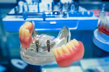 Dentistry. The layout of the gums teeth. Dental implant procedure. Implants. Denture. Demonstration...