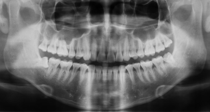 Panoramic dental x-ray image, Dental caries and treatment