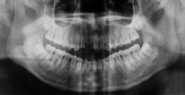 Panoramic dental x-ray image, The upper teeth are broken and loose.