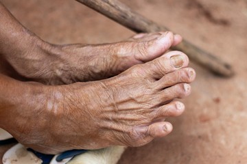 Rough skin around the feet of elderly people or farmers who have been heavily used