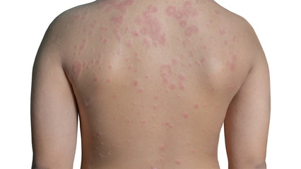 Urticaria or hives on child back with clipping paths - 301300611