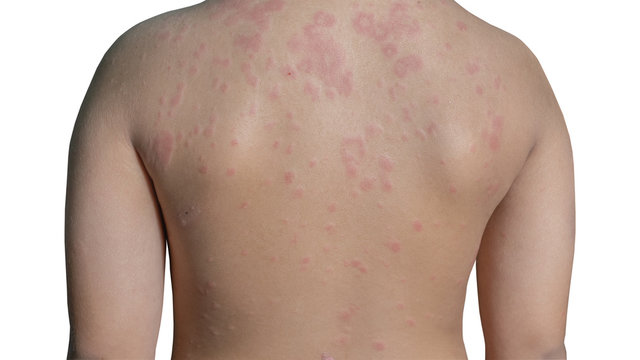Urticaria or hives on child back with clipping paths