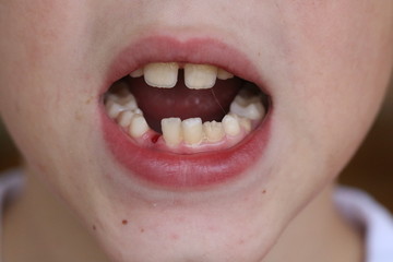 open baby mouth close-up, tooth hole bleeds, milk tooth fell out