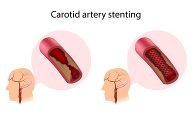 Carotid artery stenting. Before and after. Medical anatomy illustration.