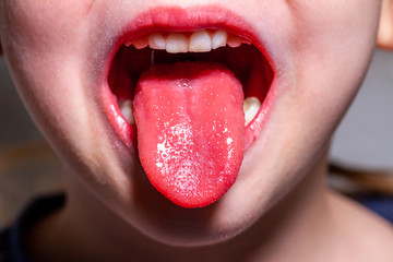 Tongue of a child with scarlet fever - strawberry tongue - obrazy, fototapety, plakaty