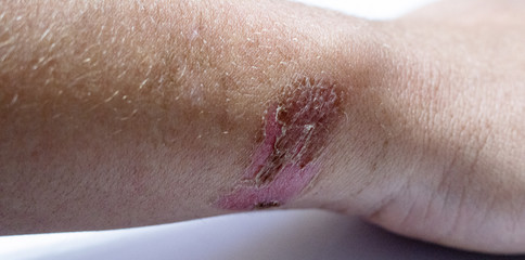 Badly healed burn on white young man's wrist