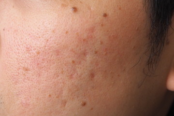 Closeup of acne and moles on the face of a young Asian man Health medical beauty aesthetics concept