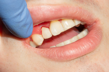 two chewing side teeth of the upper jaw after treatment of caries. Restoration of the chewing surface with a photopolymer filling material using the Rubber Dam system © Сергей Кучугурный