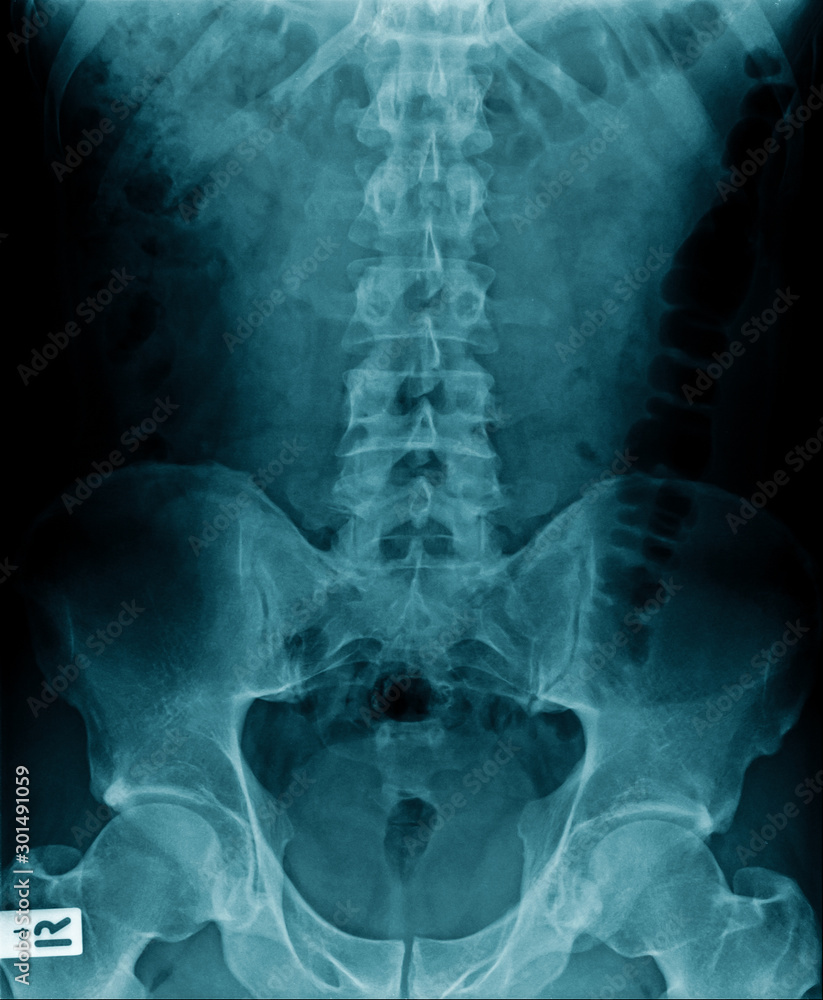 Poster x-ray image of human spine and show lumbar spondylosis