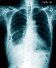 chest x-ray image in blue tone on black