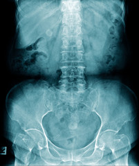 x-ray image of human spine and show lumbar spondylosis