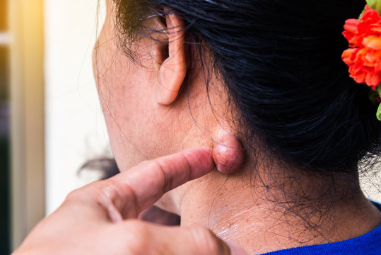 Sebaceous cyst on the neck woman form out of sebaceous gland the oil called sebum and skin treatment of laser or punch biopsy excision.Medical concepts.