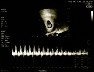 Film Ultrasound (US) whole abdomen of a 40 years old female patient scan of stomach in hospital....