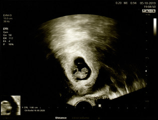Film Ultrasound (US) whole abdomen of a 40 years old female patient scan of stomach in hospital....