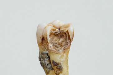 hand showing broken teeth,close up broken teeth detail.