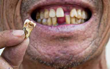 hand showing broken teeth,close up broken teeth detail.