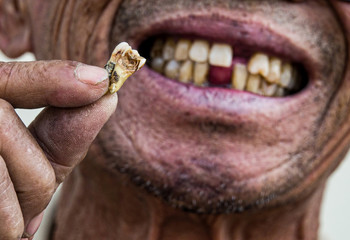 hand showing broken teeth,close up broken teeth detail.