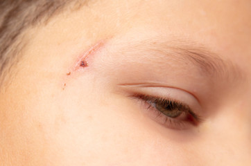 A wound on the boy's face