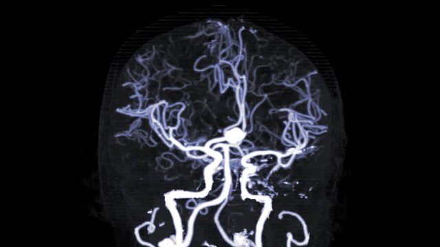 CTA Brain or computed tomography angiography of the brain a 3D Rendering image showing Anterior communicating artery or ACOM aneurysms.