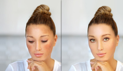 Dark spots, freckles,hyperpigmentation(melasma or chloasma)	