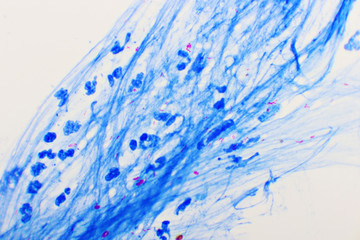 Mycobacterium tuberculosis positive (small red rod) in sputum smear, acid-fast stain, analyze by...