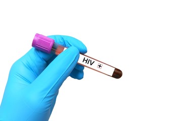 HIV positive Blood tests isolation on white background