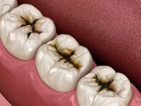 Molar teeth damaged by caries. Medically accurate tooth 3D illustration.