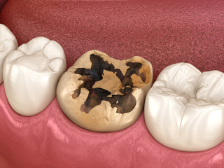 Caries removing process. Medically accurate tooth 3D illustration.