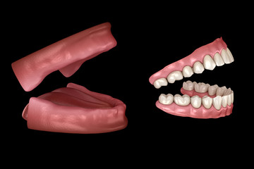 Maxillary and Mandibular prosthesis, artificial dentures. Medically accurate 3D illustration of human teeth and dentures