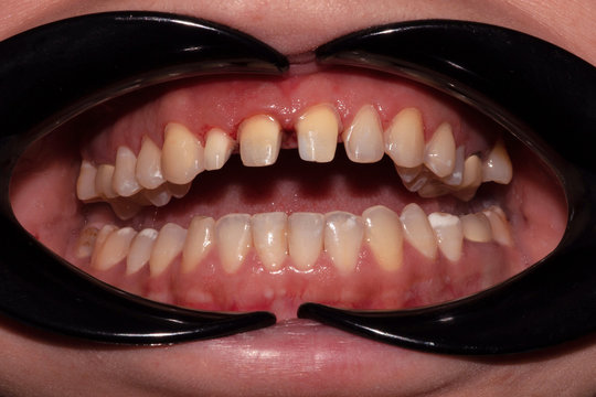 Turning and preparing teeth for ceramic veneers and crowns. Micro invasive preparation. The way to a beautiful smile.