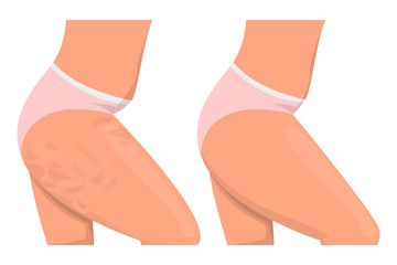 Cellulite on the hips vector isolated. Before and after, female - obrazy, fototapety, plakaty
