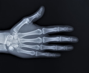 normal x-ray of the hand bones and fingers,orthopedics, medical diagnostics, rheumatology