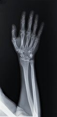 normal radiography of hand and wrist bones, traumatology and orthopedics, traumatology