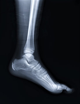 normal radiography of the ankle joint in lateral projection, traumatology and orthopedics, rheumatology