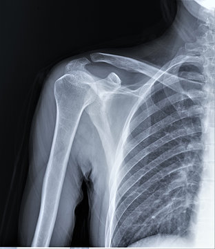 normal radiography of the shoulder joint in direct projection, traumatology and orthopedics, traumatology, sports injury