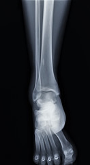 normal radiography of the ankle joint in direct projection, traumatology and orthopedics...