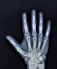 Fototapeta premium normal x-ray of the hand bones and fingers,orthopedics, medical diagnostics, rheumatology