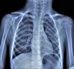 normal radiography of the shoulder joint and ribs in direct projection, Traumatology and orthopedics, traumatology, sports injury