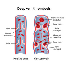 Deep vein thrombosis of legs. Image of healthy and diseased veins. Vector illustration in flat style isolated on white background