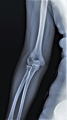 x-ray of the normal elbow joint. traumatology and orthopedics, medical diagnostics, rheumatology