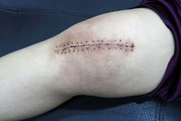 The knee replacement surgery lesions.