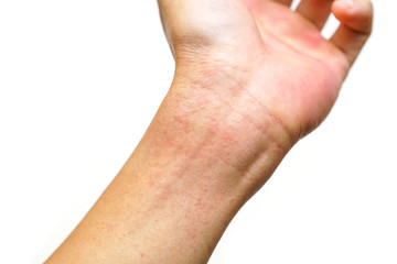 Red rash on wrist isolated on white background / Rashes  on skin caused by virus - obrazy, fototapety, plakaty