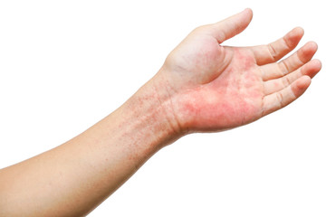 Red rash on wrist and hand isolated on white background / Rashes  on skin caused by virus - obrazy, fototapety, plakaty