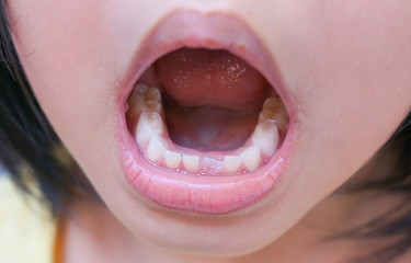 A kid losing a baby tooth and a new permanent tooth coming out