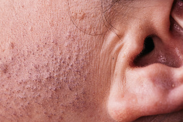 Skin face after removing hair