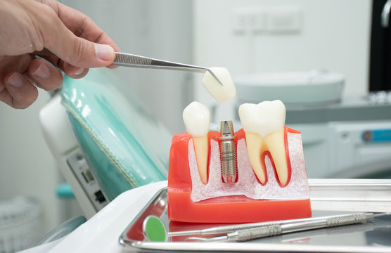 Examples of dental implants in the jawbone of the patient.